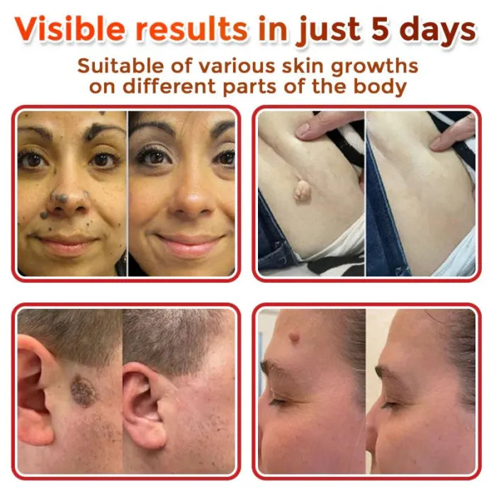 Botanic Skin Tag Removal Patch